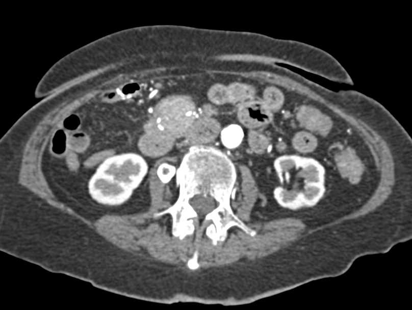 Carcinoid Tumor Root of Mesentery Encases the Superior Mesenteric Vein (SMV) - CTisus CT Scan
