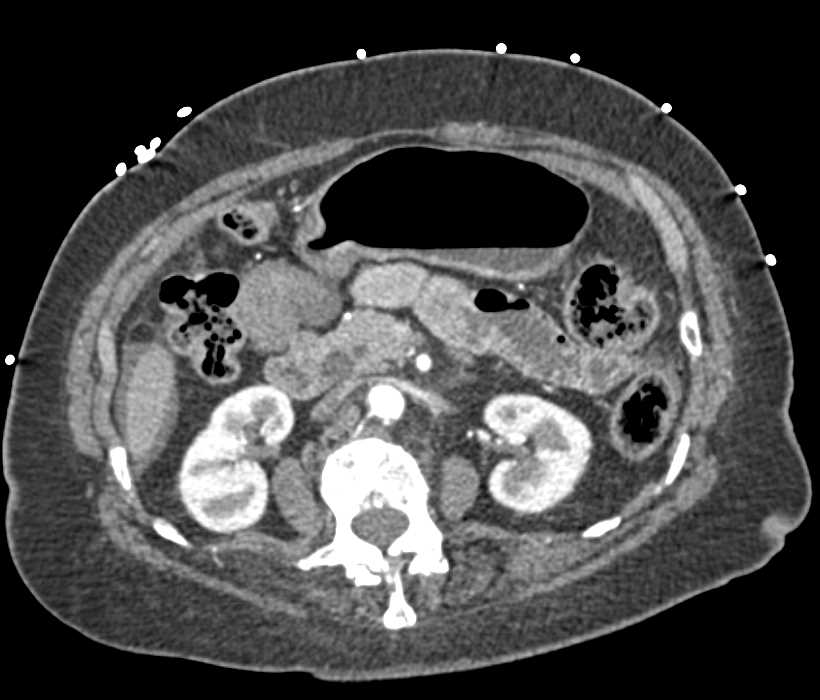 Ischemic Bowel with an Internal Hernia in the Right Lower Quadrant - CTisus CT Scan