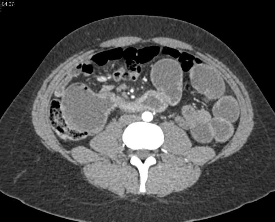 Small Bowel Obstruction (SBO) due to Stricture - CTisus CT Scan