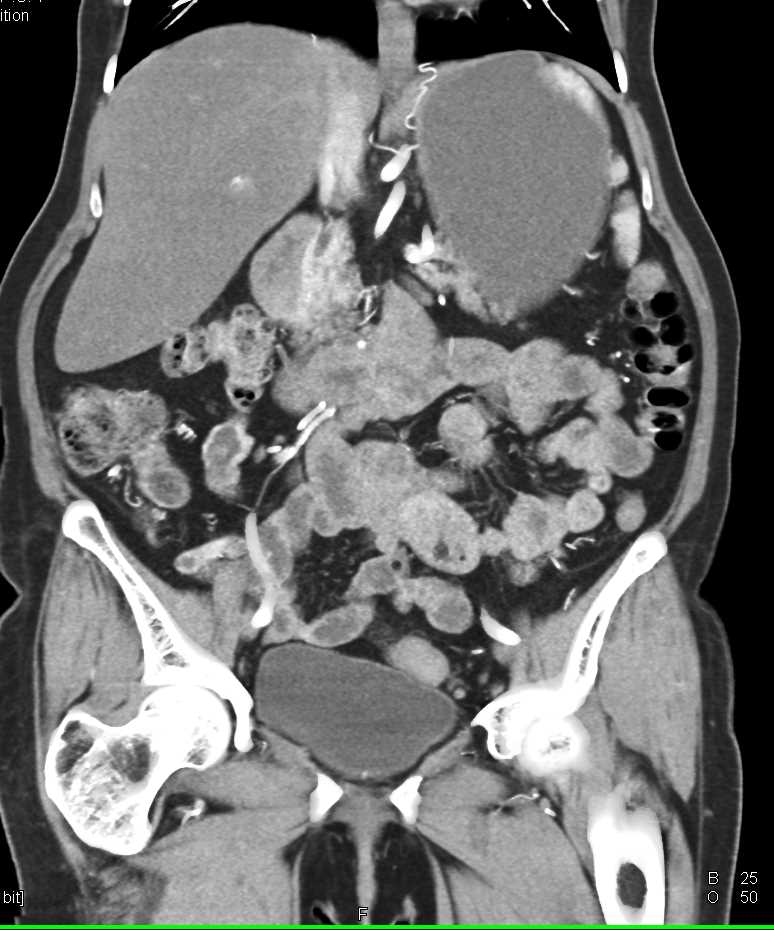 Crohn's Disease with Thickened Terminal Ileum - CTisus CT Scan