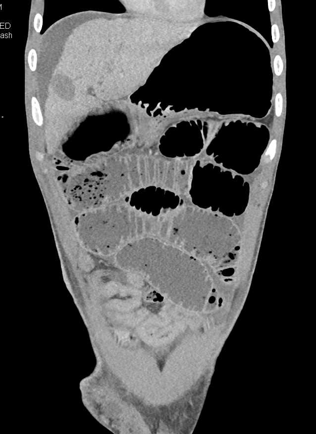 Small Bowel Obstruction (SBO) due to an Inguinal Hernia - CTisus CT Scan