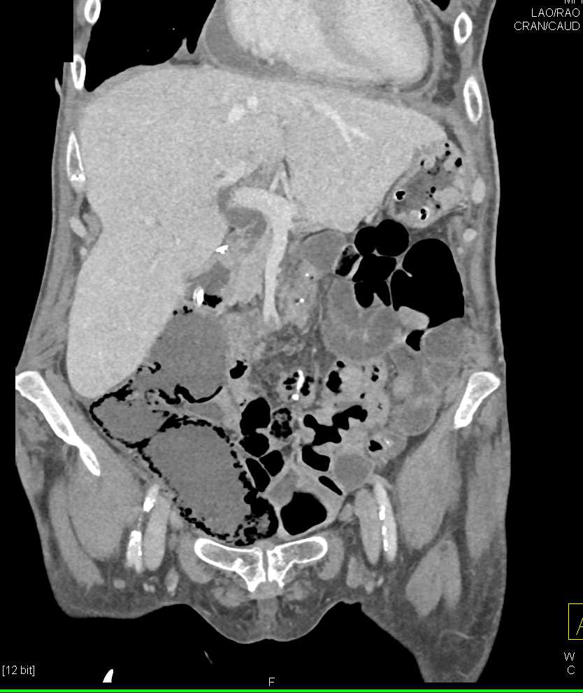 Pneumatosis Small Bowel due to Ischemic and Infarcted Small Bowel - CTisus CT Scan