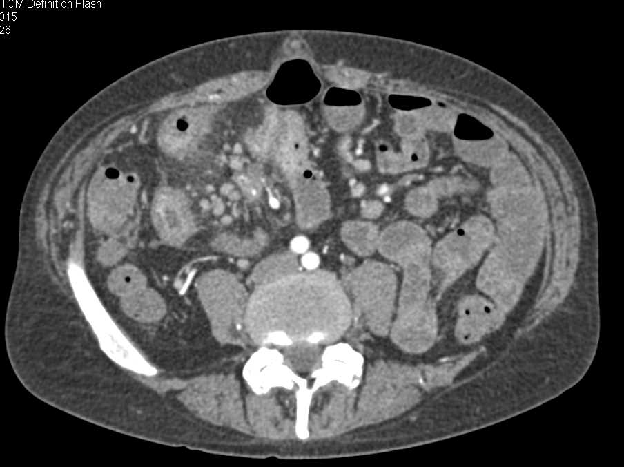 Crohn's Disease - CTisus CT Scan