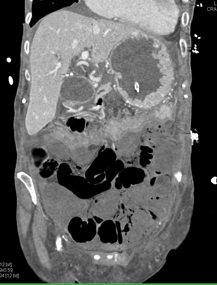 Superior Mesenteric Artery (SMA) Occlusion with Pneumatosis Small Bowel and Intestinal Ischemia - CTisus CT Scan