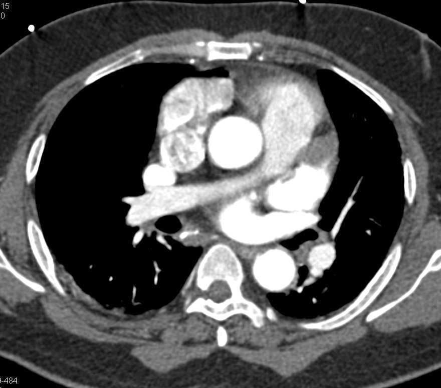 Superior Mesenteric Artery (SMA) Occlusion with Ischemic Bowel and Midgut Volvulus ad Thrombus in Left Atrial Appendage - CTisus CT Scan