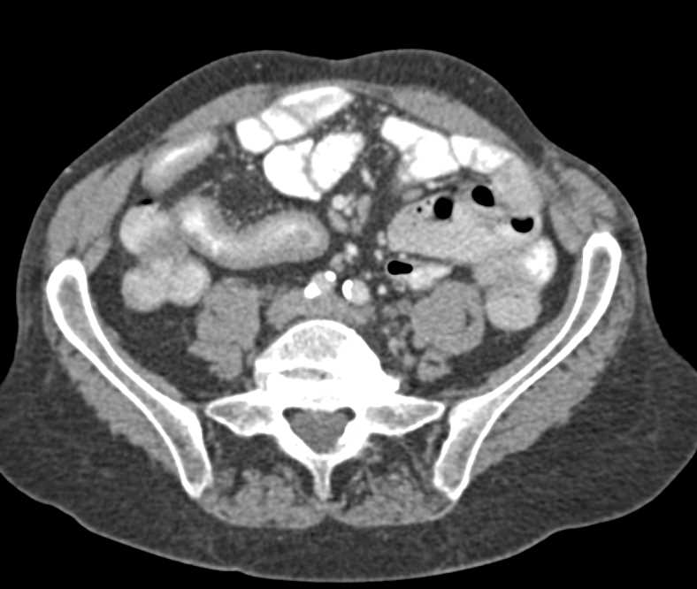 Crohn's Disease with Stricture in Terminal Ileum - CTisus CT Scan
