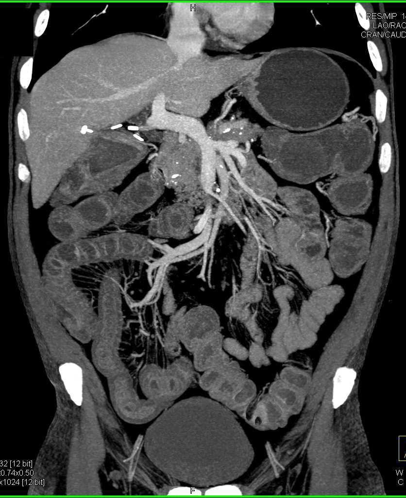 Crohn's Disease Right Colon with Nodes and Comb Sign - CTisus CT Scan