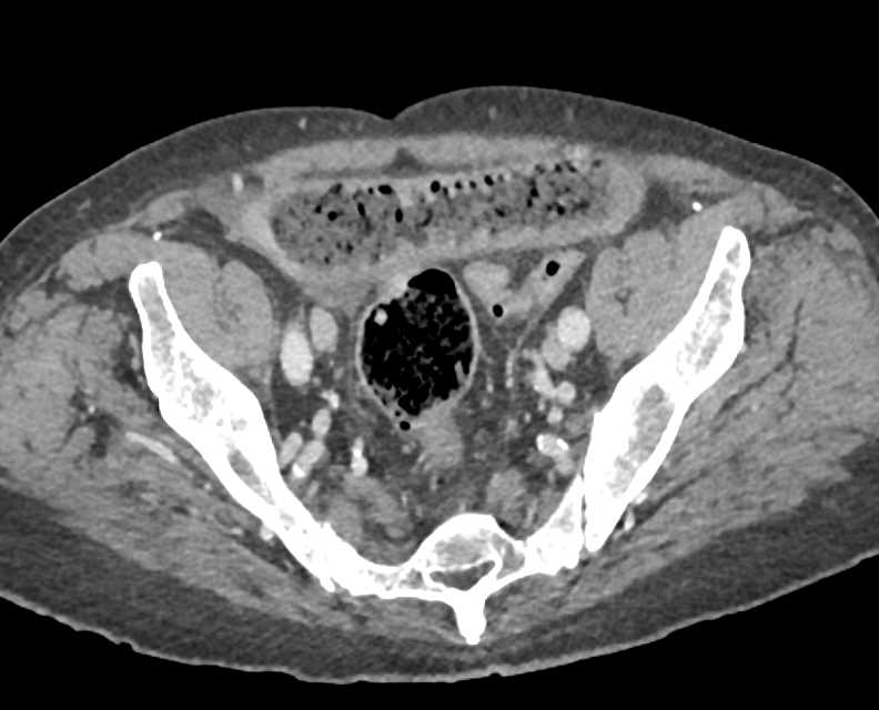 Distal Small Bowel Obstruction with Ischemic Bowel - CTisus CT Scan