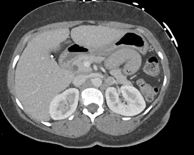 Hematoma into Duodenum and Jejunum - CTisus CT Scan