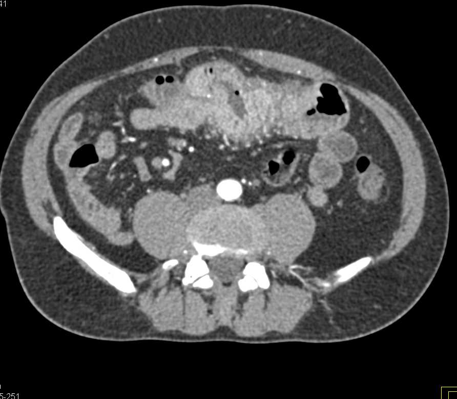Thickened Small Bowel with Enteritis - CTisus CT Scan