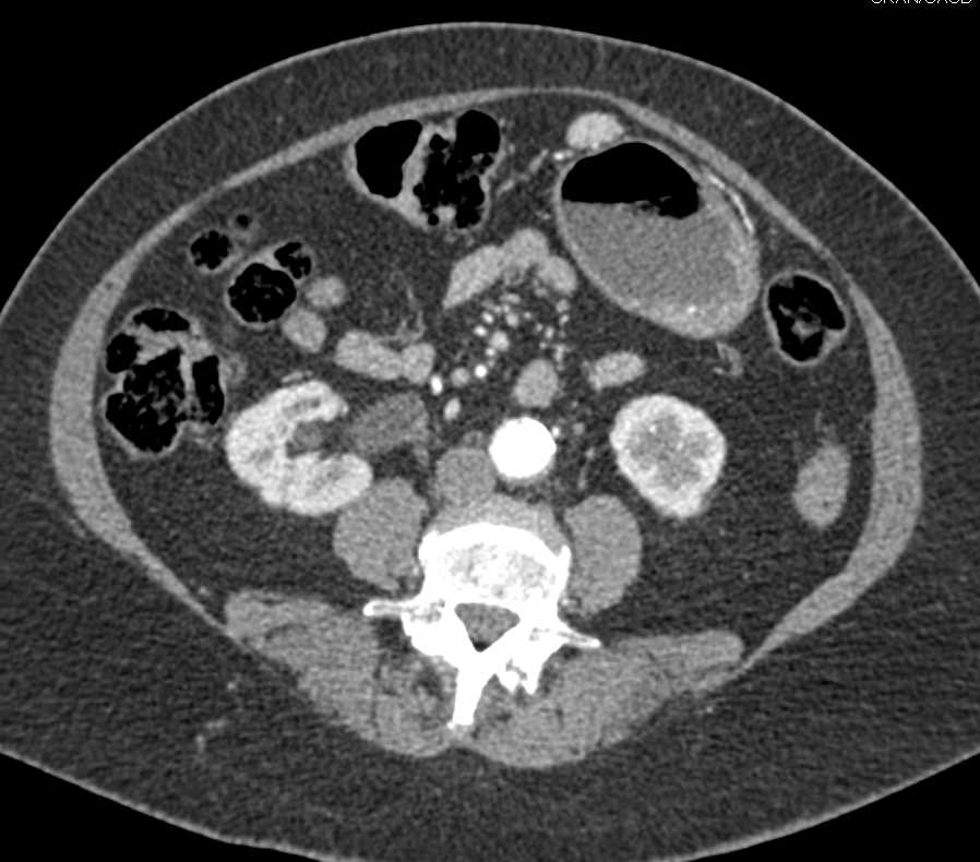 Splenules in Patient with Multiple Prior Fractures and Abdominal Trauma - CTisus CT Scan