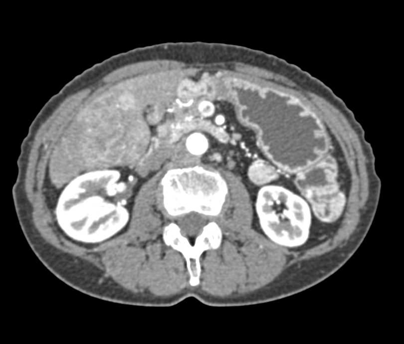 Duodenal Carcinoma on CT and PET - CTisus CT Scan
