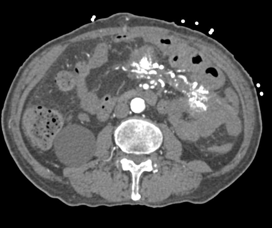 Sclerosing Mesenteritis - CTisus CT Scan