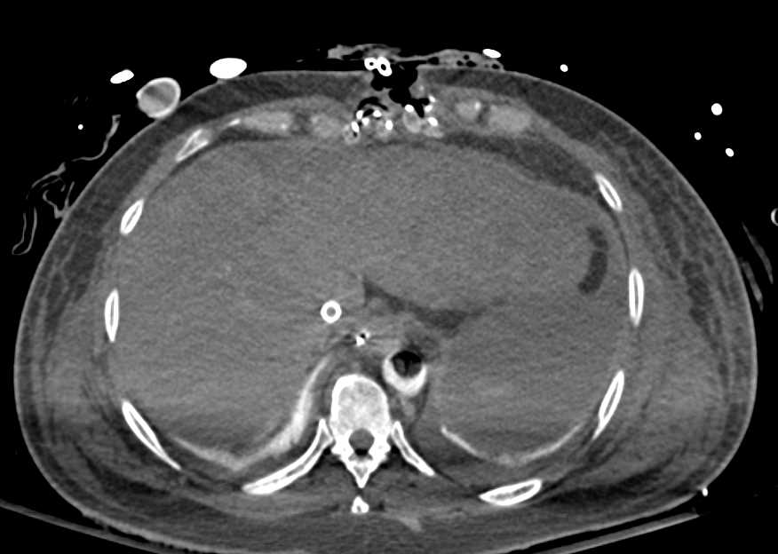 Ischemic Bowel and Pneumatosis in a Patient on a Balloon Pump - CTisus CT Scan