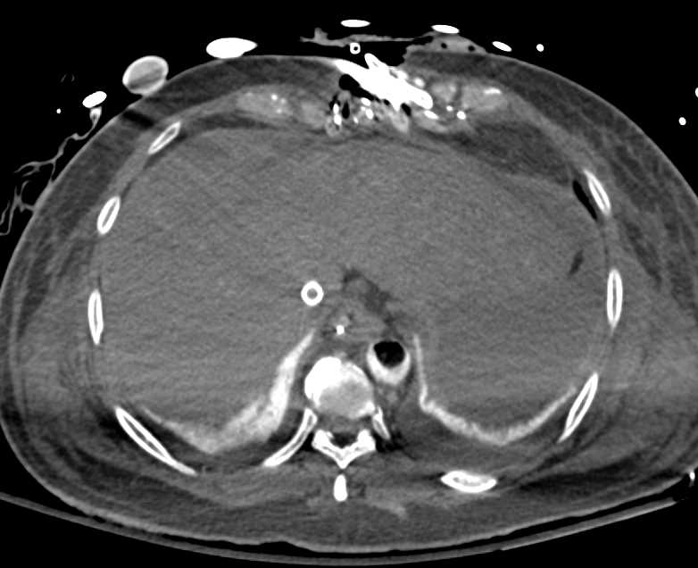 Ischemic Bowel with Pneumatosis, Ascites and Splenic Infarcts in Patient With a Intra-arterial Balloon Pump - CTisus CT Scan