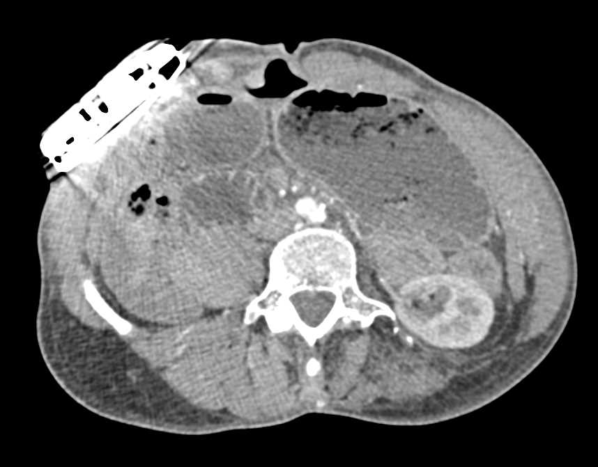 Dilated Duodenum in Superior Mesenteric Artery (SMA) Syndrome - CTisus CT Scan