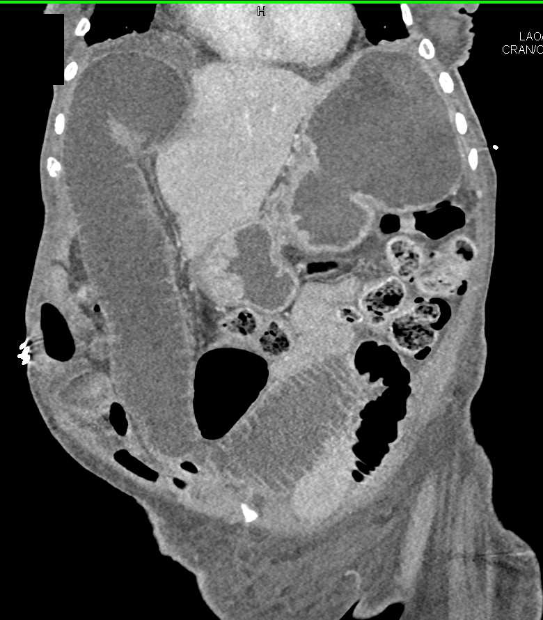 Distal Small Bowel Obstruction - CTisus CT Scan