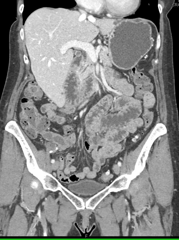 Carcinoma of the Duodenum - CTisus CT Scan