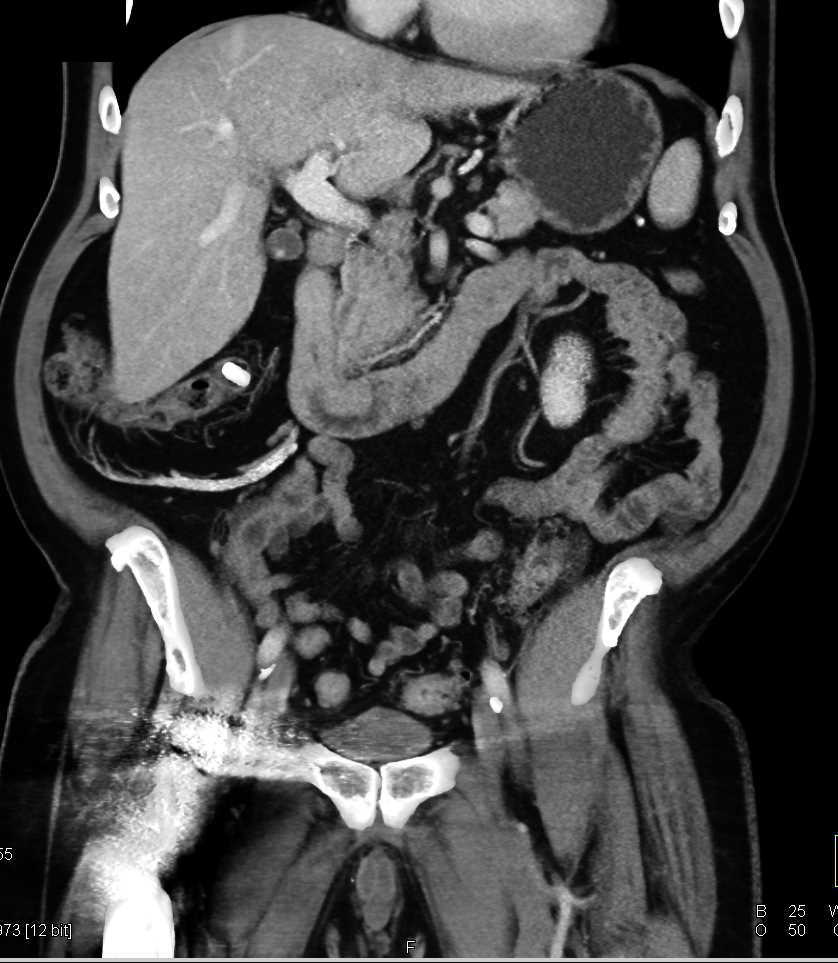 Adenocarcinoma of the Duodenum - CTisus CT Scan