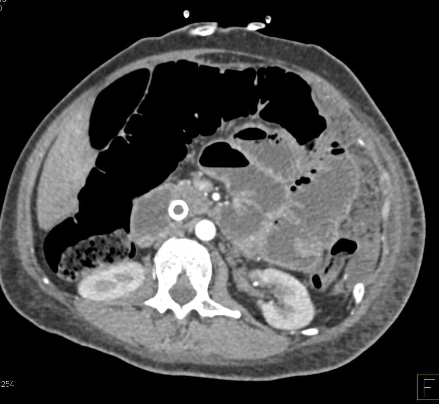 Ischemic Small Bowel with Pneumatosis - CTisus CT Scan