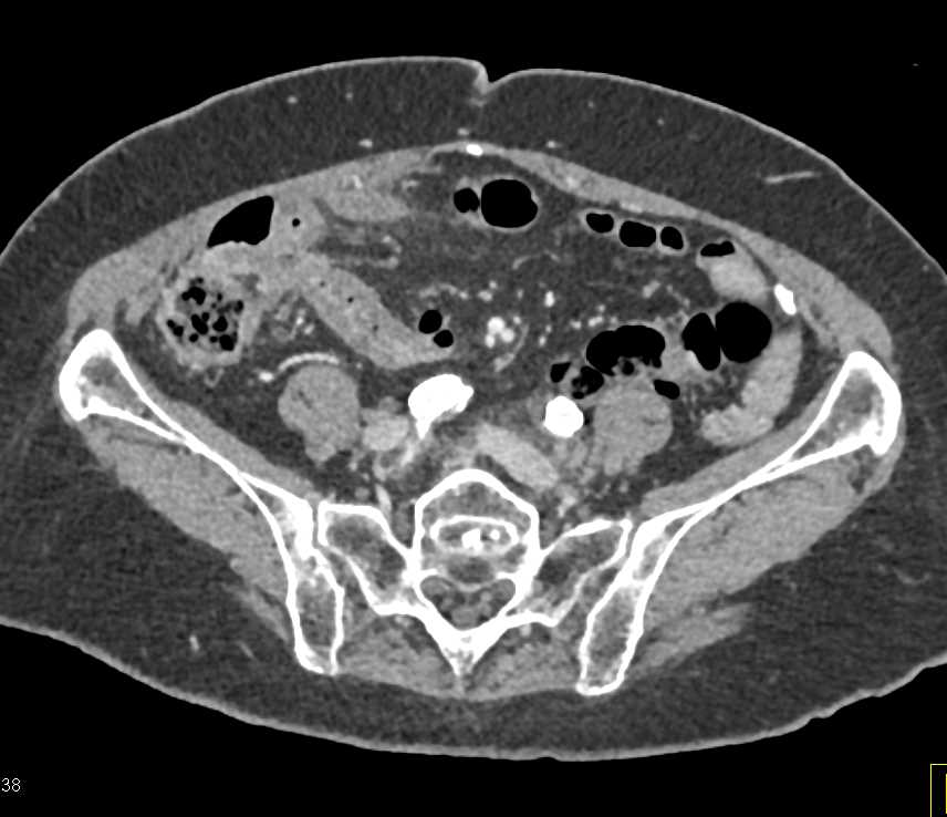 Crohn's Disease Involves the Terminal Ileum - CTisus CT Scan