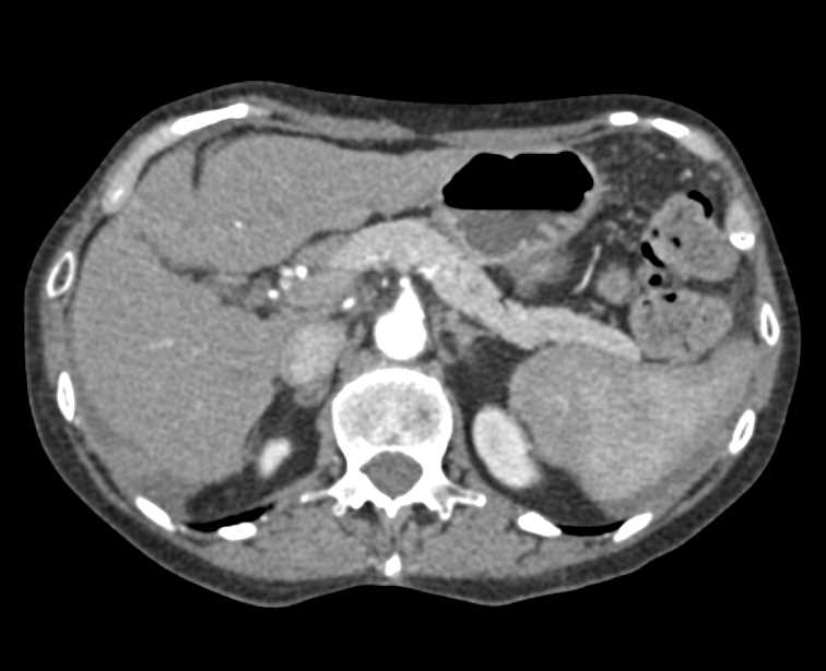 Carcinoid Tumor Right Lower Quadrant with Desmoplastic Reaction - CTisus CT Scan