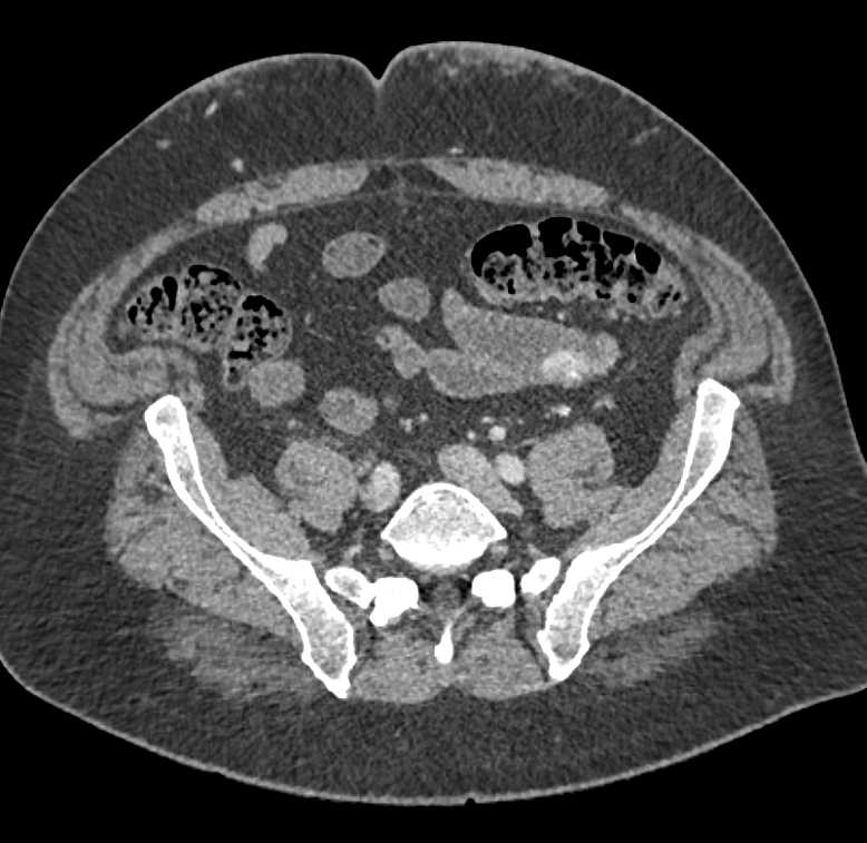 Small Bowel GIST Tumor that Bleed - CTisus CT Scan
