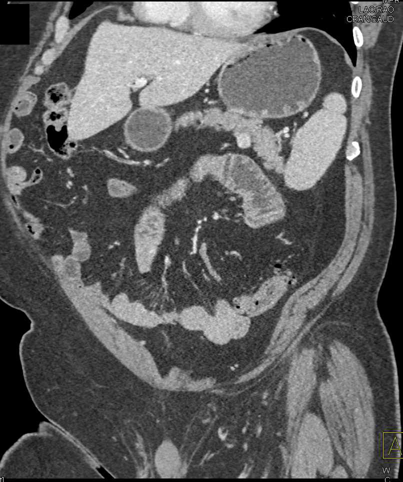 1cm GIST Tumor off Proximal Jejunum - CTisus CT Scan