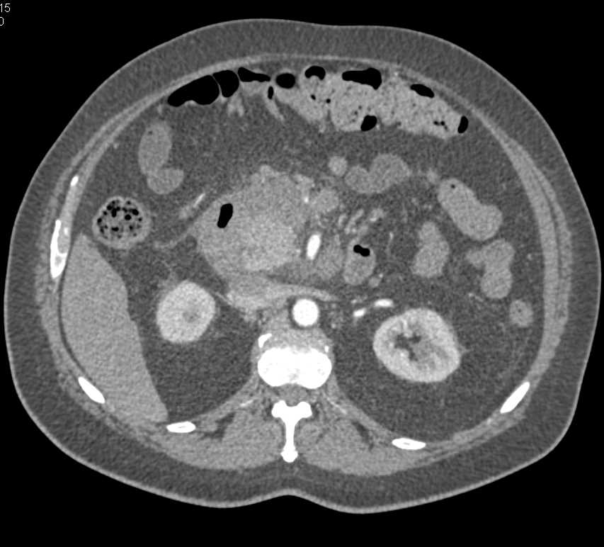 Ulcerating Duodenal Cancer Invades the Pancreas - CTisus CT Scan