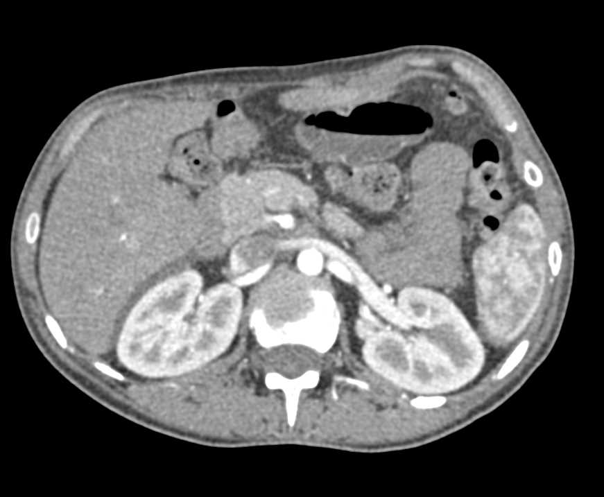 Crohn's Disease Terminal Ileum - CTisus CT Scan