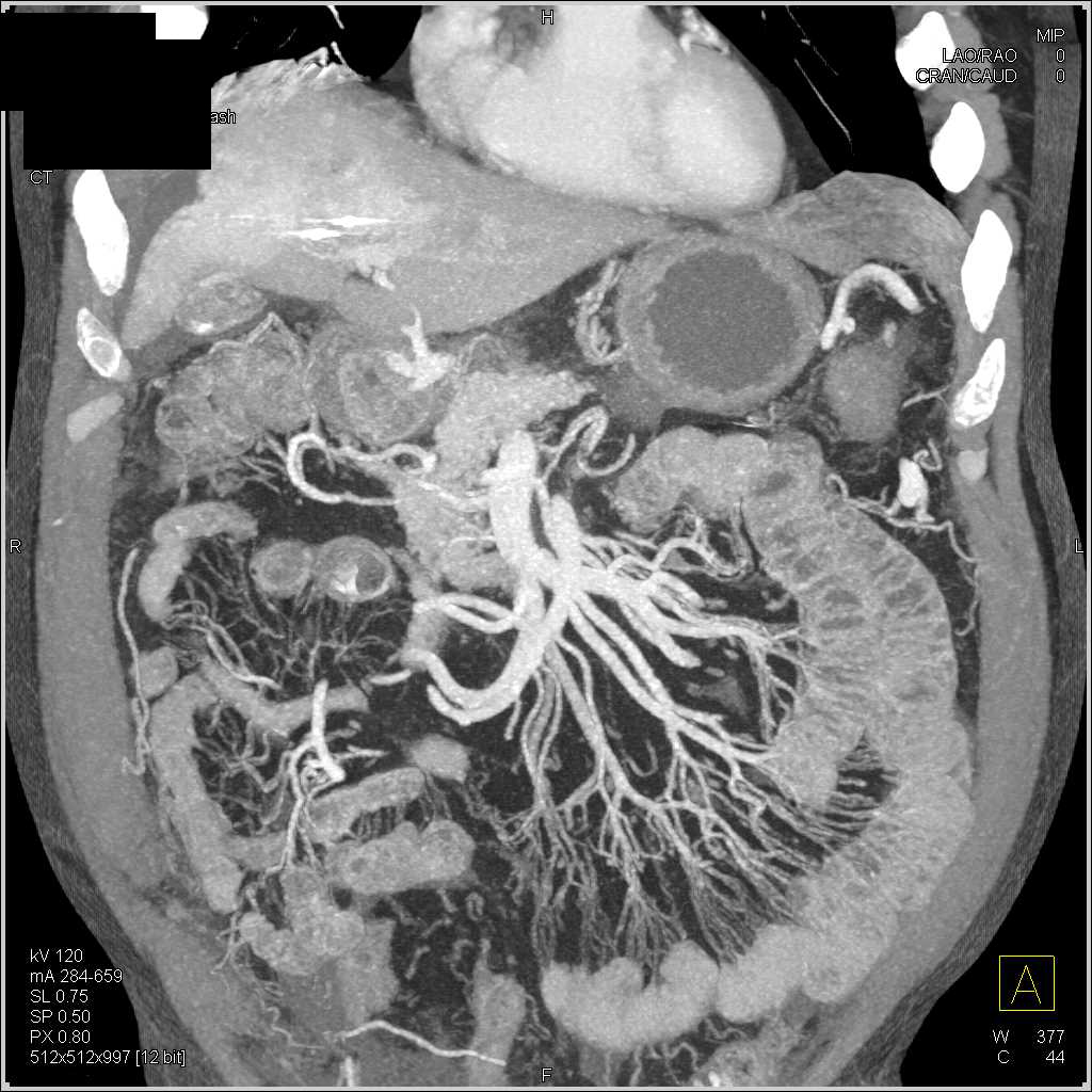 Increased Flow into the Mesenteric Arcade - CTisus CT Scan