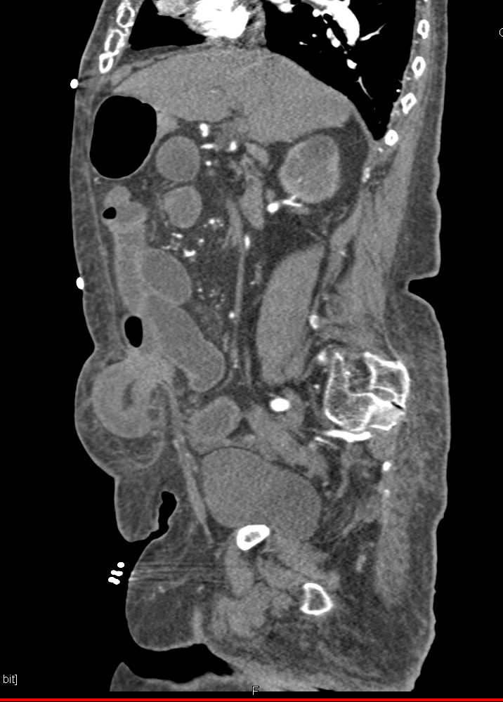 Incarcerated Ventral Hernia with Small Bowel Obstruction (SBO) - CTisus CT Scan
