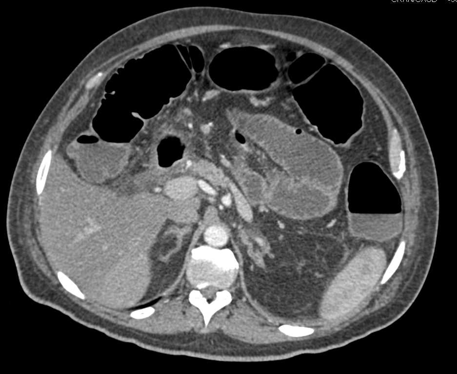Duodenal Cancer Involves the Portal Vein - CTisus CT Scan