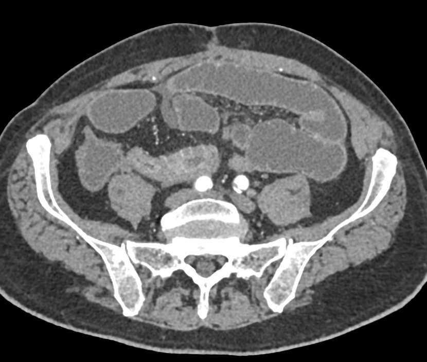 Crohn's Disease with Distal Small Bowel Obstruction - CTisus CT Scan