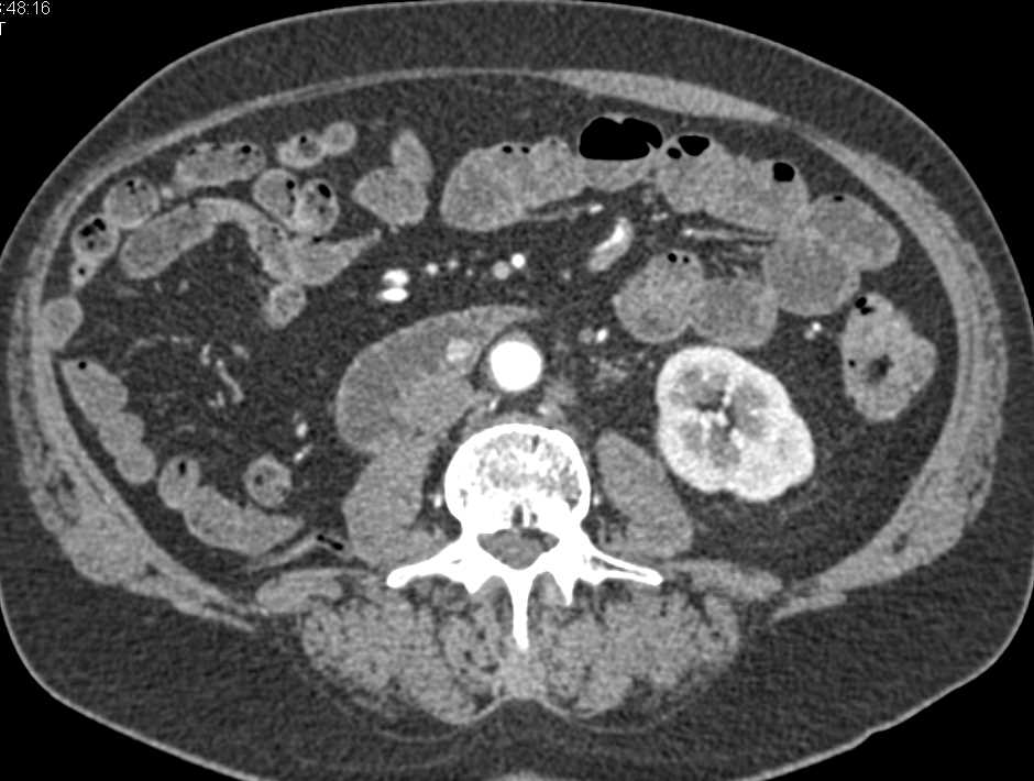 Renal Cell Carcinoma with Metastases to the Duodenum with 1cm Mass - CTisus CT Scan