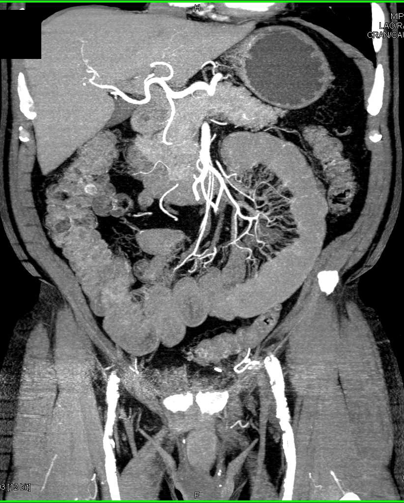Comb Sign With Enteritis - CTisus CT Scan