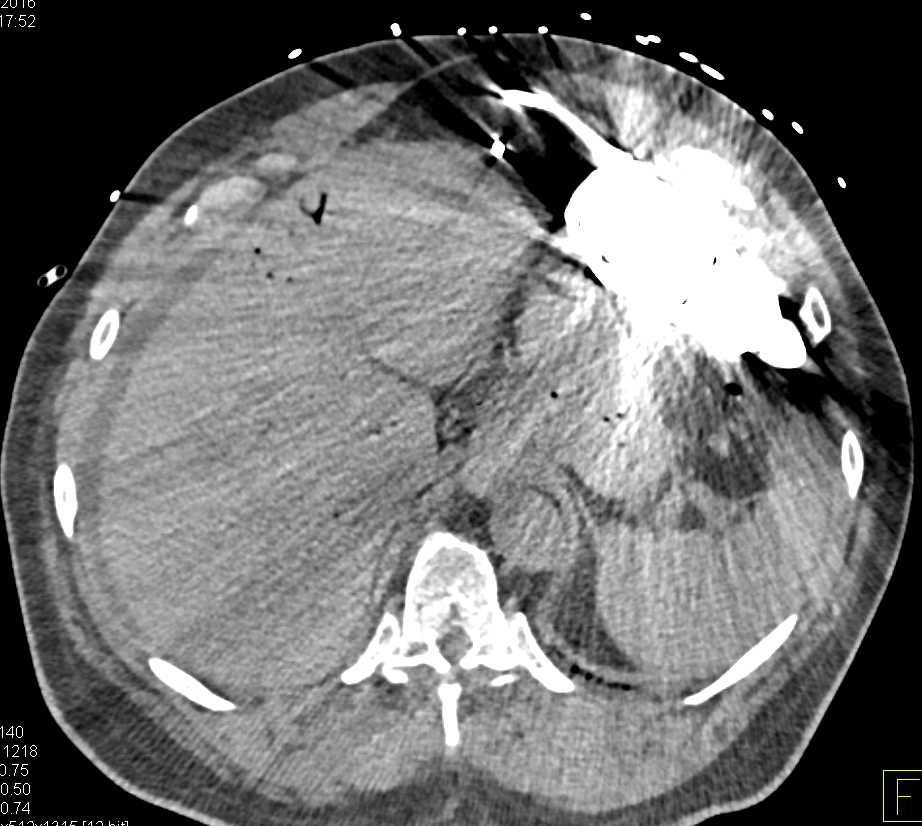 Ischemic Bowel with Pneumatosis and Air in Portal Vein and Hepatic Veins - CTisus CT Scan