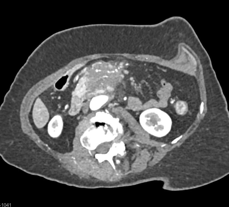 B-Cell Lymphoma Infiltrates the Root of the Mesentery - CTisus CT Scan