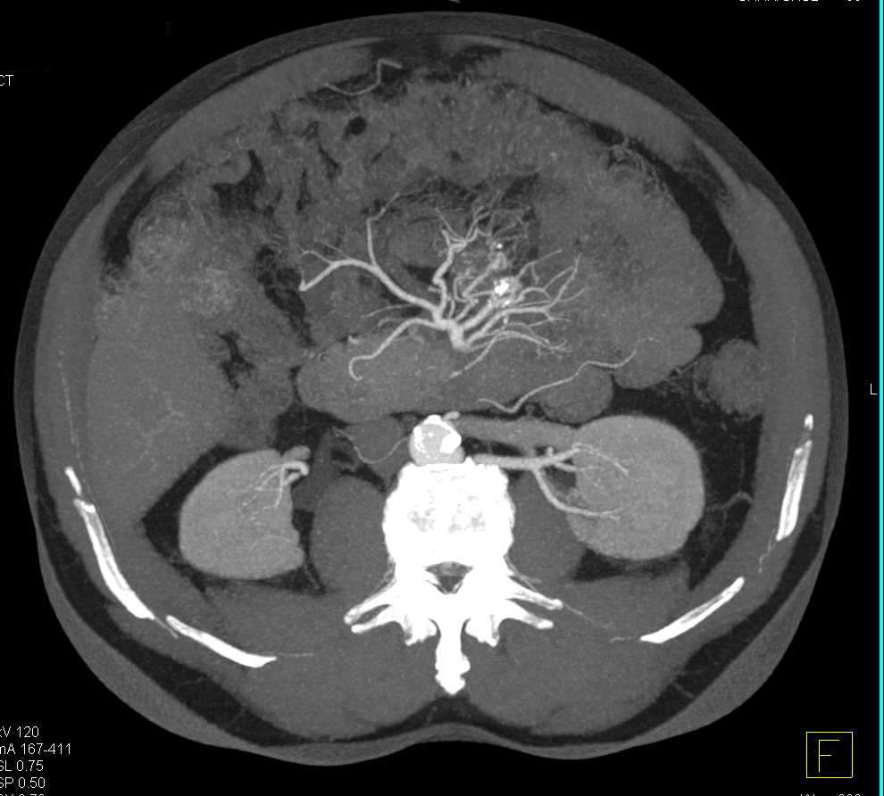 Carcinoid Tumor Root of Mesentery with Desmoplastic Reaction - CTisus CT Scan