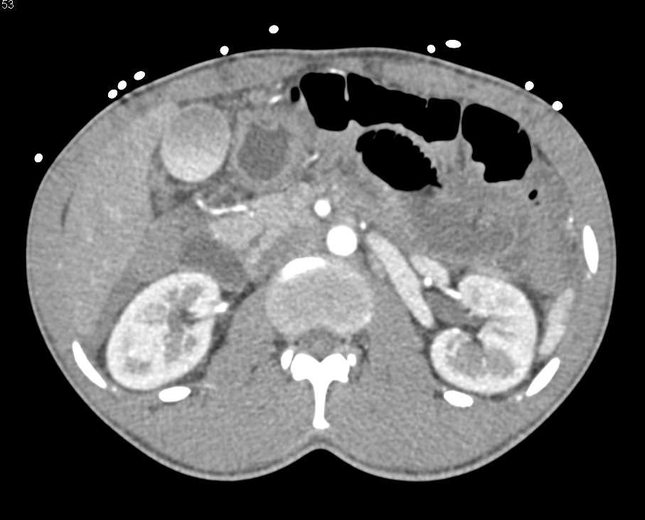 Small Bowel Hemorrhage in Anti-Coagulated Patient - CTisus CT Scan