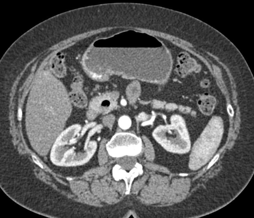 Angiodysplasia Small Bowel - CTisus CT Scan
