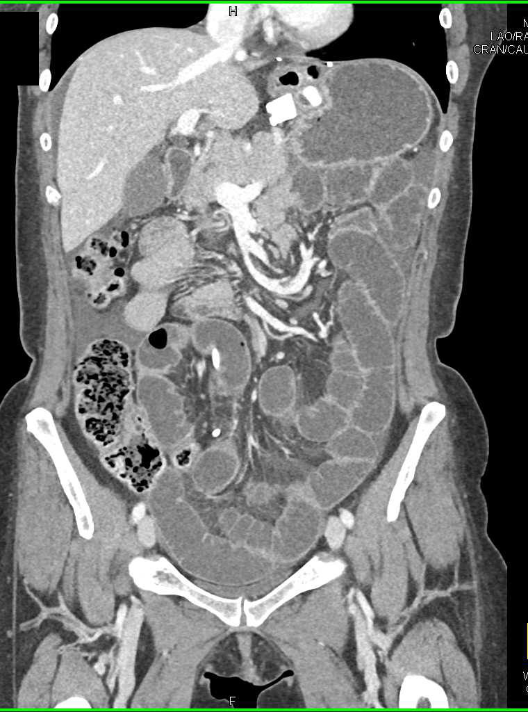 Small Bowel Obstruction due to Adhesions - CTisus CT Scan