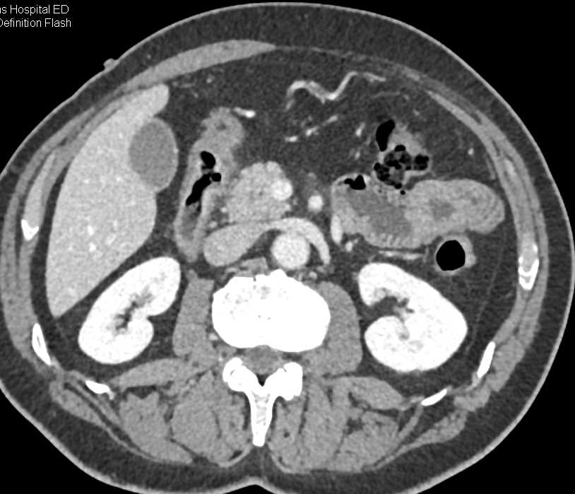 Duodenal Carcinoma with Ulcer - CTisus CT Scan