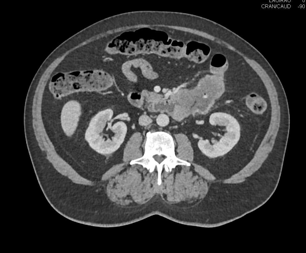 Jejunal Adenocarcinoma with Liver Metastases - CTisus CT Scan