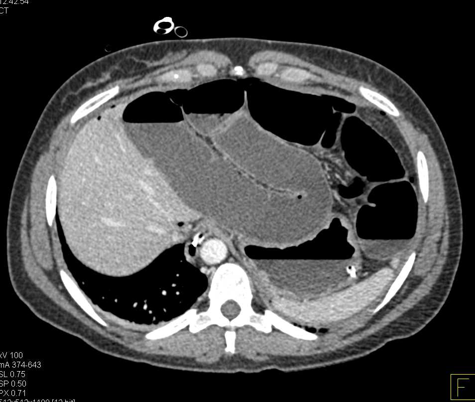Small Bowel Obstruction (SBO) due to Adhesions - CTisus CT Scan