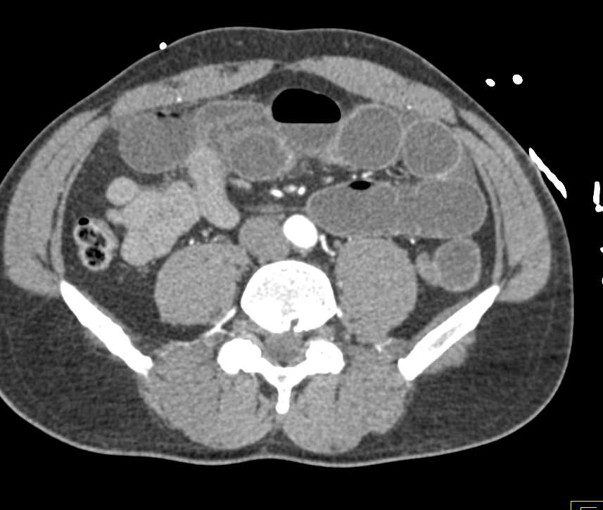 Small Bowel Obstruction (SBO) with Midgut Volvulus - CTisus CT Scan