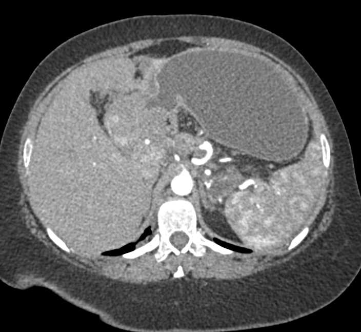 Antral Carcinoma with Dilated Stomach and Carcinomatosis - CTisus CT Scan