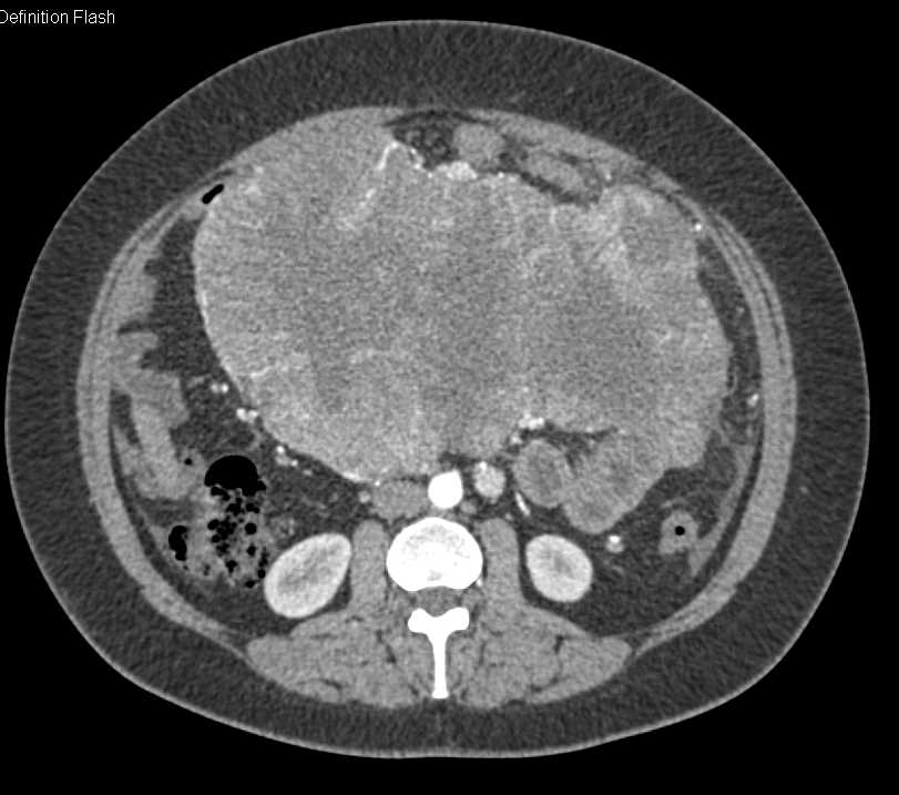 GIST Tumor off Duodenum Extends into the Pelvis - CTisus CT Scan