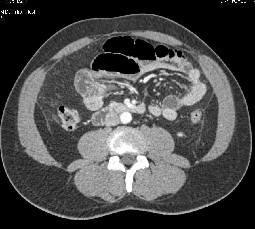 Scrotal Edema with Small Bowel Hernia and Ischemic Bowel - CTisus CT Scan
