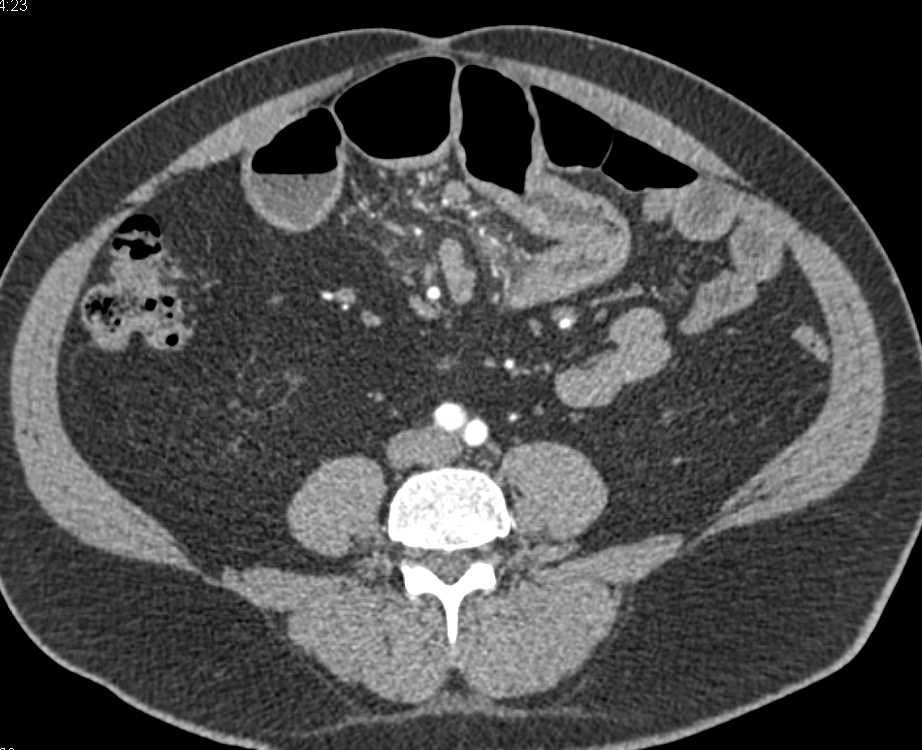 Jejunal Diverticulitis with Inflammation - CTisus CT Scan
